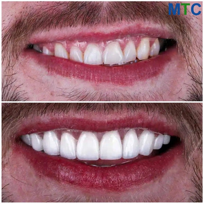 Veneers in Turkey Cost A Detailed Exploration